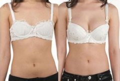 自体脂肪隆胸术后应该注意什么问题？