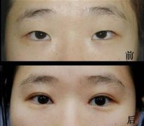 韩式双眼皮是永久的吗