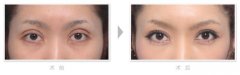 双眼皮术后留疤了怎么办