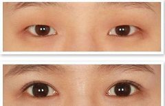 上睑下垂上眼皮松弛怎么办？