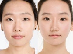 隆鼻后鼻子真的会移动吗?