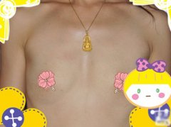假体隆胸三个月 乳沟好深