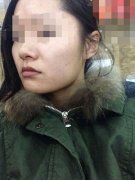 打完瘦脸针后 我完全迷上了自己