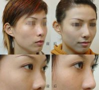 上海百达丽整形医院做隆鼻整形价格多少？