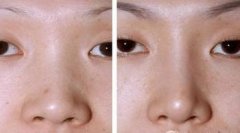 上海玫瑰整形医院做隆鼻整形安全吗?多少钱?