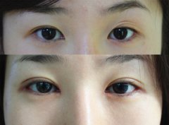 绍兴维美美容医院做双眼皮多少钱？好不好？