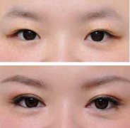 绍兴维美美容医院开眼角多少钱?好不好?