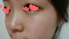 隆鼻 小改变助我美丽蜕变~