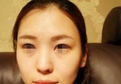 我的驼峰鼻终于消失了~来炫一下