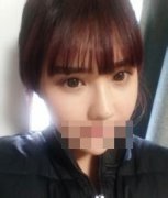 硅胶隆鼻整形 4个月了