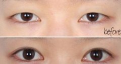 上海眼皮下垂矫正手术怎么样?