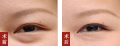 男士祛眼袋的方法是什么?