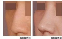 鹰钩鼻要怎么矫正?