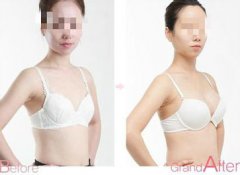 上海哪里做韩式隆胸整形好?多久可以恢复?