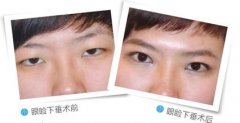 广州曙光医学美容医院上睑下垂矫正多少钱?好不