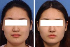 广州曙光医学美容医院鼻翼缩小多少钱?好吗?