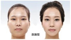 磨下颌角有什么风险？贵吗？