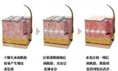 水光注射——让肌肤亮白净透，美出新高度！