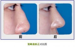 想解决驼峰鼻，要先了解它