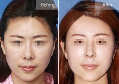 上海做修复假体隆鼻的医院那个好？