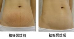 激光去妊娠纹有什么优势？具体有哪几种？