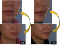 脸部吸脂手术是怎样做的