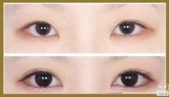 成都做修复双眼皮个医院好?