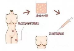 自体脂肪隆胸的好处有哪些？自体脂肪隆胸的介