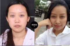上海做朝天鼻纠正需要多少钱？