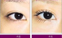 做开眼角手术后的注意事项有哪些?