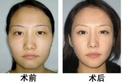 上海做丰太阳穴手术有危险吗