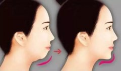 上海美联臣做假体隆下巴的效果好不好