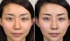 北京做假体鼻子的修复需要多少钱