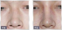 北京做朝天鼻改善的专家
