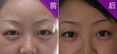 重庆肿眼泡的眼睛可以做双眼皮手术不？