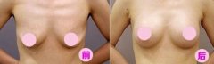 成都军大做乳房下垂矫正手术价格？
