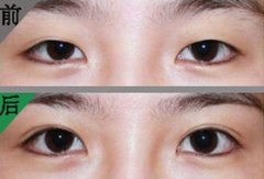海南做韩式双眼皮术后需要拆线吗?