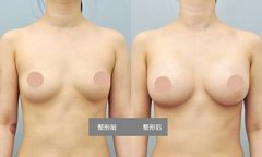 成都做乳房下垂纠正手术会留疤吗？