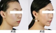 北京京民整形假体隆下巴怎么做