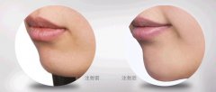 上海联合丽格北做丰下巴的方法有哪些