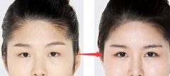 上海美莱整形医院开眼角手术多少钱?哪个医生好