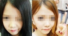 大家快来看看  做了鼻子之后是不是我脸也显小了