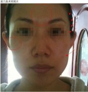 成都丰苹果肌效果图，面部变得更加有立体感了