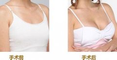 北京协和医院做假体隆胸多少钱?能保持多久?