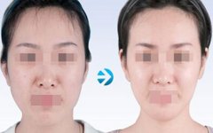 北京玻尿酸丰太阳穴多少钱?维持多久?