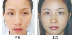 上海做假体丰太阳穴价格是多少?
