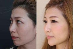 肉毒素注射除皱效果怎么样呢？