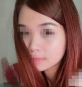 自体软骨隆鼻对比照 轻松拥有娇俏美鼻