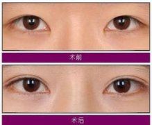 厦门做双眼皮手术需要多少钱呢?