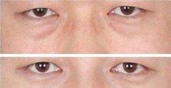 北京激光去眼袋多少钱？要几次才能祛除？